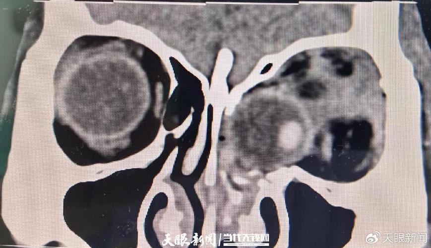 做实验时突然爆炸，碎玻璃扎入男子左眼，医生紧急手术保其视力